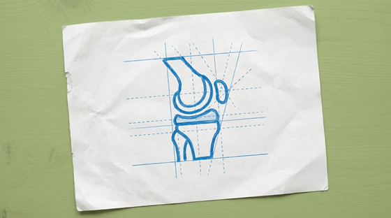 an artificial knee joint prosthesis